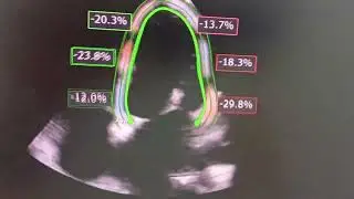 2D Speckle Tracking Strain of LV and LA post Balloon Mitral Valvuloplasty !!