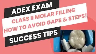 ADEX Exam Prep Feedback on Class II Molar Filling: How to Avoid Gaps and Steps!