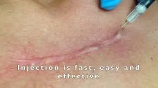 Keloid Injection by Dr. Shafa at OC MedDerm in Irvine, CA #dermatology #keloidtreatment
