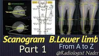 سكانوجرام للطرفين السفليين الجزء الاول( الميكانيكي) Scanogram B.lower limb.part 1(Mechanical Axis)