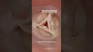 Rheumatic aortic valve stenosis: how it affects the heart. Explained in 3D by VOKA
