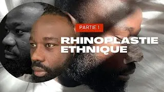 MA RHINOPLASTIE ETHNIQUE 