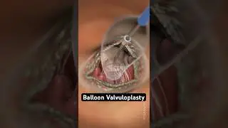 Simple balloon vs. open-heart surgery (3D animation)