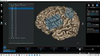 Intracranial EEG Montage Creator ECoG Grid placement