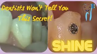How to Get a Tooth Gem &ndash; Dentist Explains! 4K