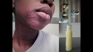 HOW TO: acne treatment at home with Onion juice | AMIFULLEST BEAUTY