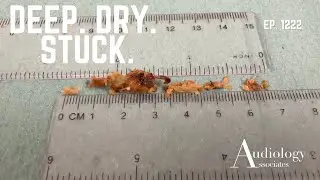 Deep, Impacted Ear Wax & Dry Skin Removal | Very Difficult Cases - EP1222