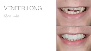 edelweiss LONG NECK VENEER &ndash; Open bite