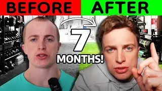Hair Transplant | TOP 10 QUESTIONS