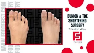 Bunion Surgery with the Sklar Bunionectomy&reg; & our Unique Toe Shortening Procedure 💥 #bunions #toes