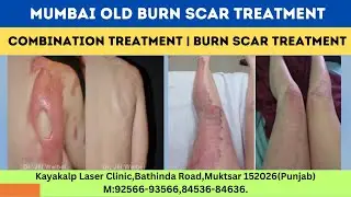 Mumbai Old Burn Scar Treatment | Combination Treatment | Burn Scar Treatment