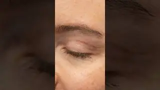 #schlupflider  #lidstraffung #oberlid #lidkorrektur #oberlidstraffung #plastischechirurgie