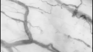 Sublingual Microcirculation in MIS-C During the Acute Phase and Follow-Up Compared With Controls