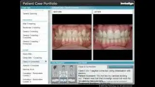 Invisalign Class II Correction