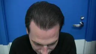 Hair Transplant Before After - Dr Hasson Patient - 4600 Grafts