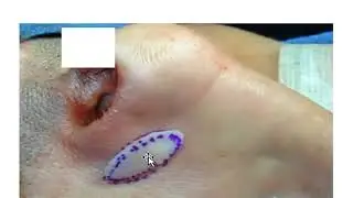 Nasal Valve Surgery &ndash; Functional Rhinoplasty in San Francisco &ndash; Dr  David Kim