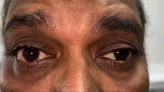 Myasthenia Gravis- eye signs