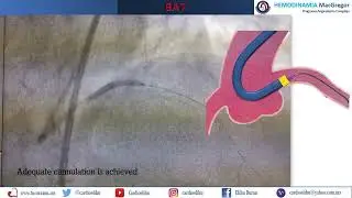 BAT para mejorar canulaci&oacute;n
