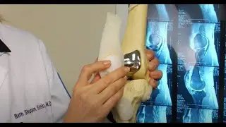 Surgery for Patellofemoral Arthritis by Dr. Shubin Stein