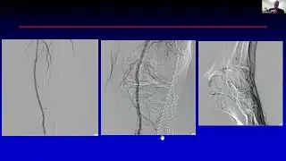 Atherectomy and Calcium Ablative Therapies