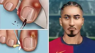 [ASMR Animation] Help Raphinha remove splinter from toenail