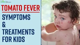 Tomato Flu: Tomato Fever In Kids | बच्चों में क्यों फैल रहा है ये वायरस?, Expert से जानें