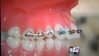 Fastbraces - Orthodontics - Straight Teeth In Palm Beach Gardens, FL