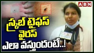 స్క్రబ్ టైఫస్ వైరస్ ఎలా వస్తుందంటే.!| Doctor about Scrub Typhus Virus  Symptoms | AP | ABN Telugu