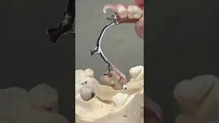 Metal Partial and Crown Attachment #dental #teeth #smile #lsk121shorts #shortvideo #shorts