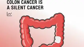 Colon Cancer Doesn&rsquo;t Start With Pain &mdash; These Are the Early Signs