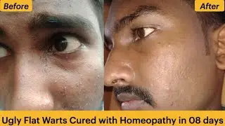 Flat warts for one and Half years getting cured in 8 days
