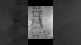 Acute limb ischemia resulting from a CERAB stent occlusion #artery #vascular #hospital