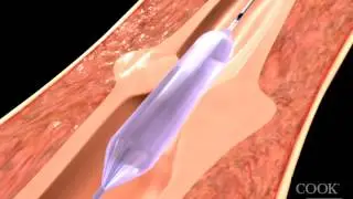 Hercules&reg; 3 Stage Balloon Dilator Animation