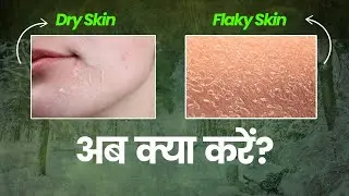 सर्दियों में रूखी और फटी त्वचा से बचने के लिए बेस्ट नेचुरल उपाय | Dr. Kashish Kalra