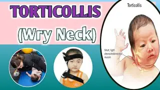 What is Torticollis? Neck Exercises for baby