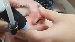SkinBase Microdermabrasion Facial | JoFo
