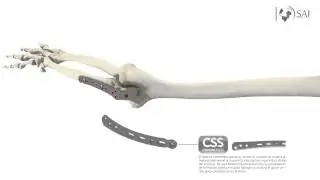 South America Implants S.A. - DC-508-00 Sistema OCL