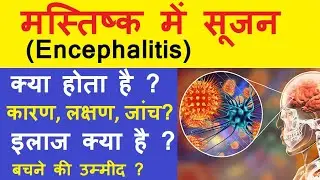 Encephalitis in hindi | Encephalitis क्या होता है | Encephalitis का  इलाज | Encephalitis लक्षण, कारण
