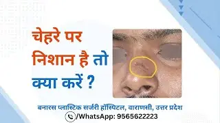 चेहरे पर निशान है तो क्या करें | Surgical Excision for Scars in Varanasi | Face Par Nishan Ka Ilaj