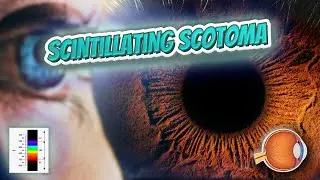 Scintillating scotoma (Your EYEBALLS) 👁️👁️💉😳💊🔊💯✅