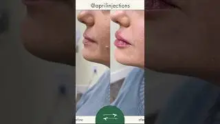 #lipfillerbeforeandafter