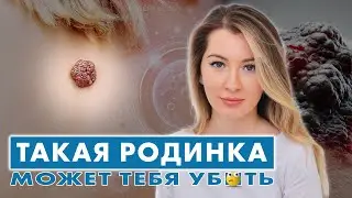 ОПАСНЫЕ РОДИНКИ: как распознать РАК? // МЕЛАНОМА // #онкологМочалова