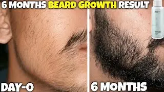 Mars minoxidil 6 months results | mars beard oil review | mars minoxidil review | minoxidil beard