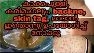 Home remedy to remove Skin Tag, Freckles, Backne, Pigmentation at home| Part 2
