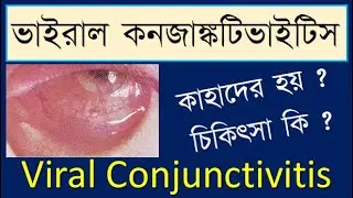Viral conjunctivitis: symptoms and treatment: #viralconjunctivitis, #viralConjinctivitisTreatment