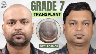 Grade 7 Hairloss | Grade 7 hair transplant | Grade 7 hair transplant result | Grade 7 Baldness | QHT