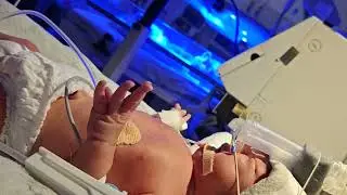 Preterm Baby on CPAP Support | NICU Care for Premature baby