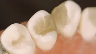 Class IV upper 3 & Class II upper 4 composite filling restoration ((part 2))