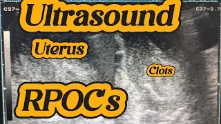 How to Ultrasound RPOC's | Managing RPOC with Ultrasound | Retained Products of Conception