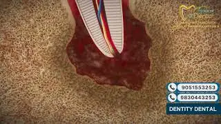 Apical Pathology Explained | Root Tip Infection Causes, Symptoms & Treatment | Dentity Dental